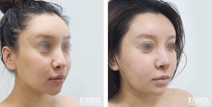 زرع الأنف / تجميل الأنف التعزيزي 67 lg 6494958e619dc image