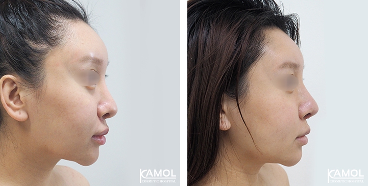 زرع الأنف / تجميل الأنف التعزيزي 65 lg 6494958e63a1b image