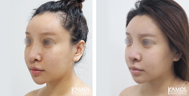 زرع الأنف / تجميل الأنف التعزيزي 68 lg 6494958e65930 image
