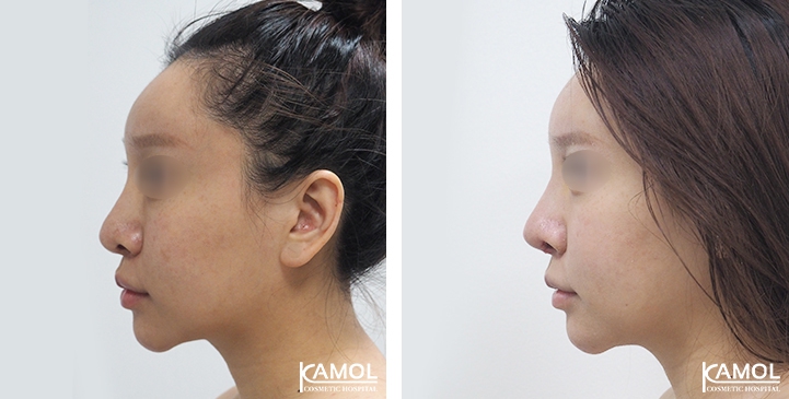 زرع الأنف / تجميل الأنف التعزيزي 66 lg 6494958e6776f image