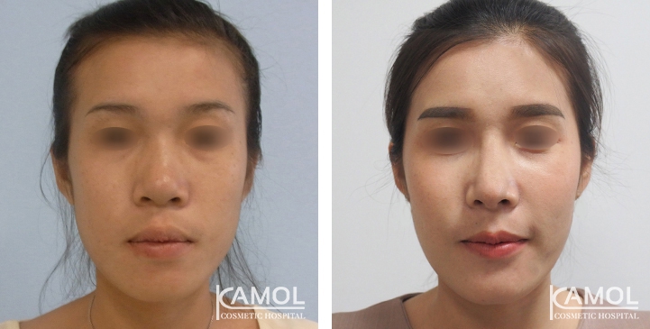 زرع الأنف / تجميل الأنف التعزيزي 71 lg 6494958e6d5e6 image