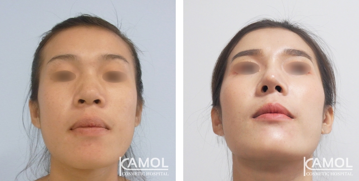 زرع الأنف / تجميل الأنف التعزيزي 74 lg 6494958e6fcfd image