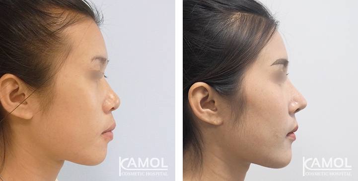 زرع الأنف / تجميل الأنف التعزيزي 72 lg 6494958e723b6 image