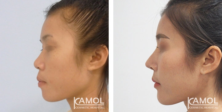 زرع الأنف / تجميل الأنف التعزيزي 73 lg 6494958e74897 image