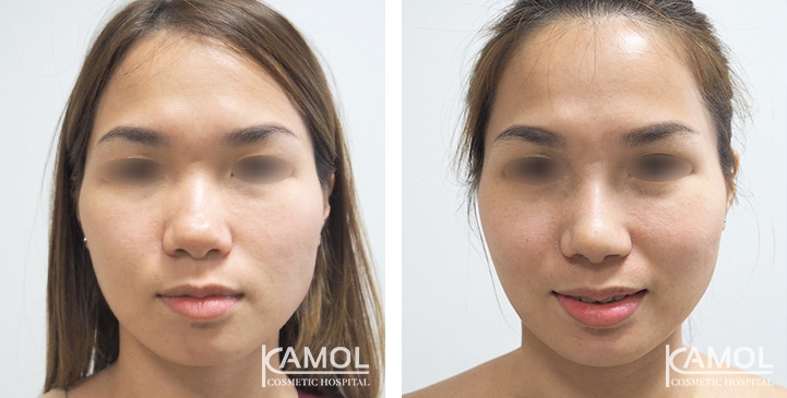زرع الأنف / تجميل الأنف التعزيزي 76 lg 6494958e775b9 image