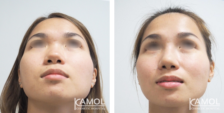 زرع الأنف / تجميل الأنف التعزيزي 79 lg 6494958e7966b image
