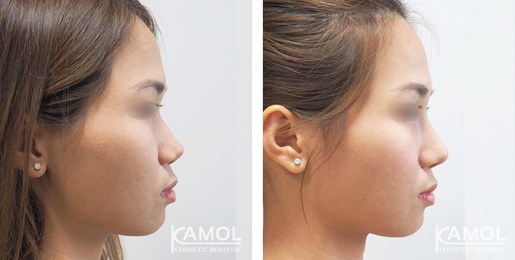 زرع الأنف / تجميل الأنف التعزيزي 77 lg 6494958e7b821 image