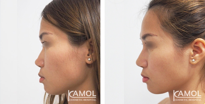 زرع الأنف / تجميل الأنف التعزيزي 78 lg 6494958e7d613 image