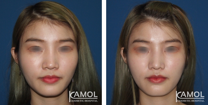 زرع الأنف / تجميل الأنف التعزيزي 81 lg 6494958e81180 image