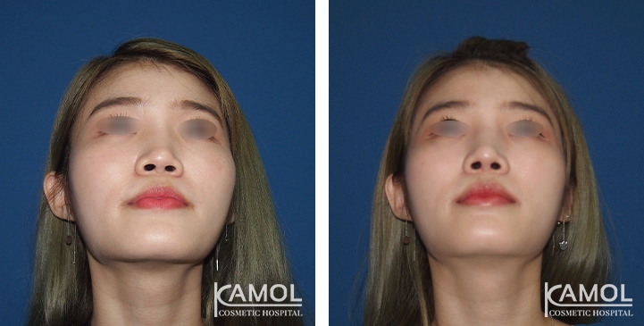زرع الأنف / تجميل الأنف التعزيزي 84 lg 6494958e83579 image