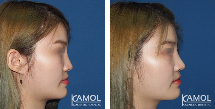 زرع الأنف / تجميل الأنف التعزيزي 82 lg 6494958e85975 image