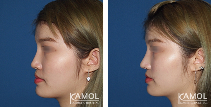 زرع الأنف / تجميل الأنف التعزيزي 83 lg 6494958e879f1 image
