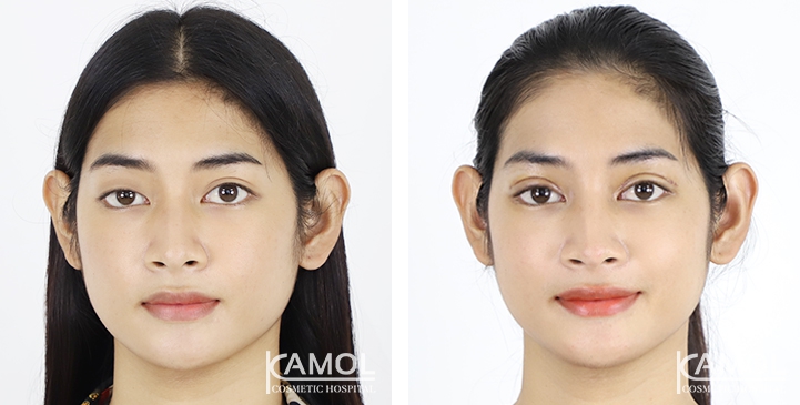 Blepharoplasty / Eyelid Surgery 10 lg 6494958e8dced image