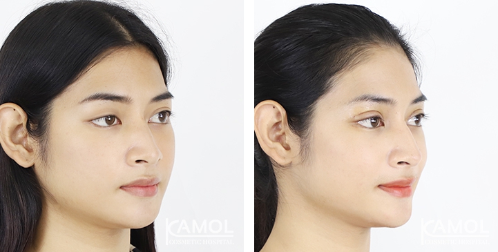 Blepharoplasty / Eyelid Surgery 11 lg 6494958e8ff3e image