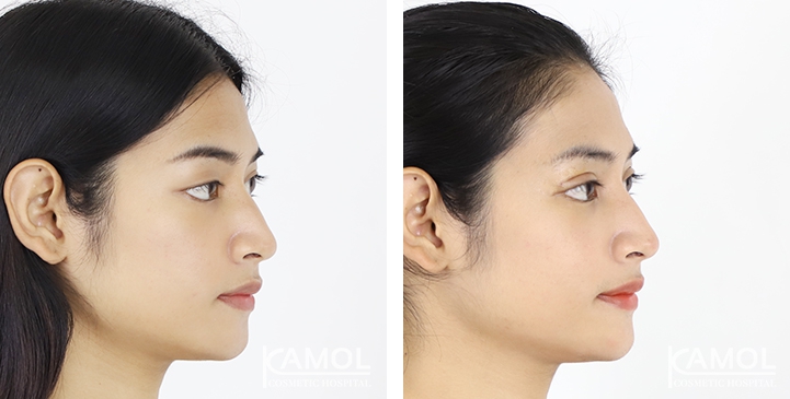 Blepharoplasty / Eyelid Surgery 12 lg 6494958e91e7e image