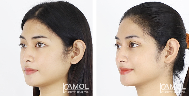 Blepharoplasty / Eyelid Surgery 13 lg 6494958e93ed8 image