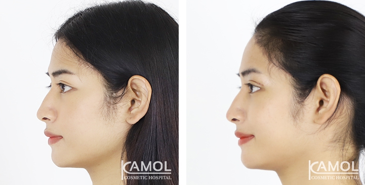Blepharoplasty / Eyelid Surgery 14 lg 6494958e95db2 image