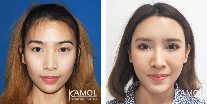 Blepharoplasty / Eyelid Surgery 28 lg 6494958e98bc9 image