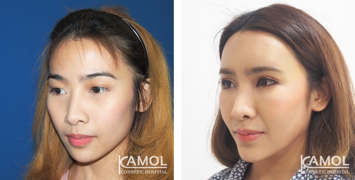 Blepharoplasty / Eyelid Surgery 30 lg 6494958e9af2e image