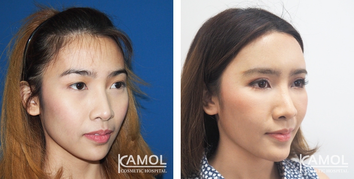 Blepharoplasty / Eyelid Surgery 29 lg 6494958e9cffd image