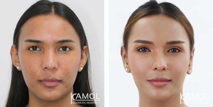 Blepharoplasty / Eyelid Surgery 32 lg 6494958e9fcb0 image
