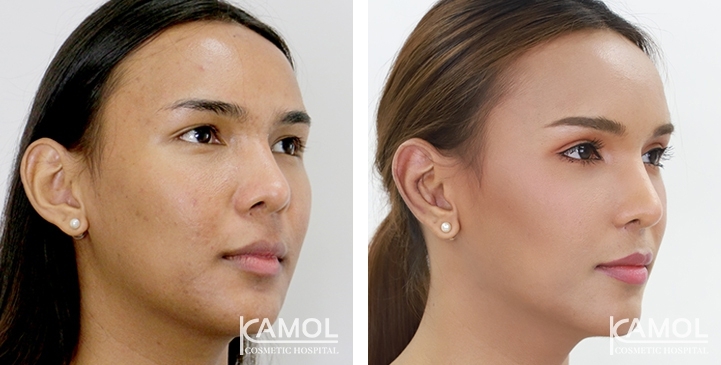 Blepharoplasty / Eyelid Surgery 34 lg 6494958ea1c8d image