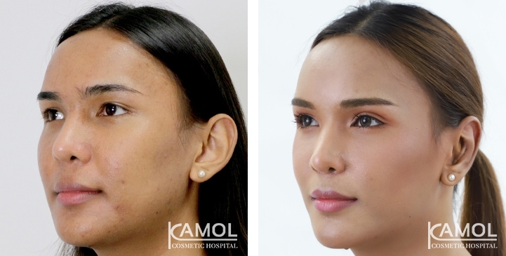 Blepharoplasty / Eyelid Surgery 33 lg 6494958ea3d02 image