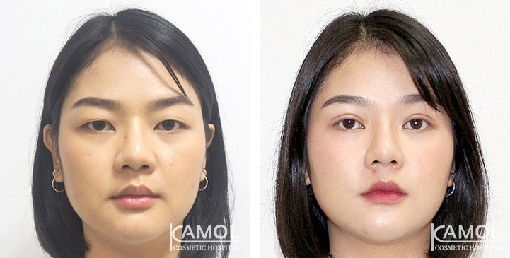 Blepharoplasty / Eyelid Surgery 36 lg 6494958ea69df image