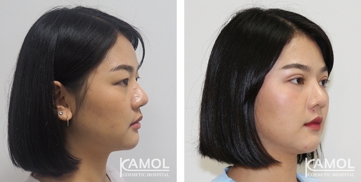 Blepharoplasty / Eyelid Surgery 37 lg 6494958ea8d23 image