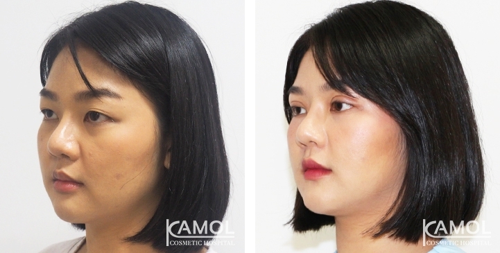 Blepharoplasty / Eyelid Surgery 38 lg 6494958eaadb6 image