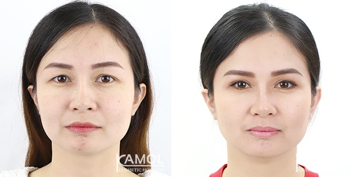 Blepharoplasty / Eyelid Surgery 40 lg 6494958eadd7c image