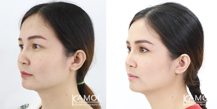 Blepharoplasty / Eyelid Surgery 41 lg 6494958eaff05 image