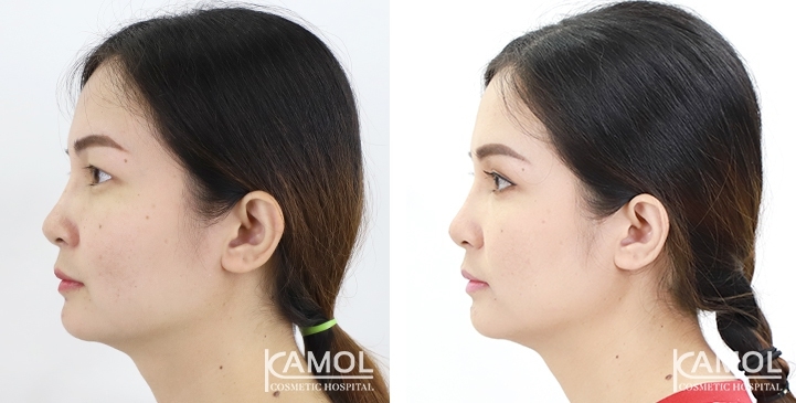 Blepharoplasty / Eyelid Surgery 42 lg 6494958eb1ef8 image