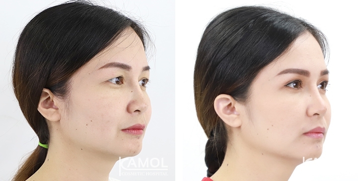Blepharoplasty / Eyelid Surgery 43 lg 6494958eb3ed9 image