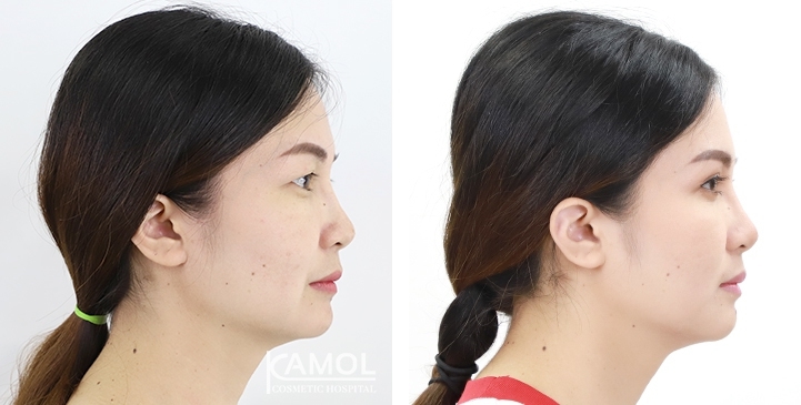 Blepharoplasty / Eyelid Surgery 44 lg 6494958eb60e7 image