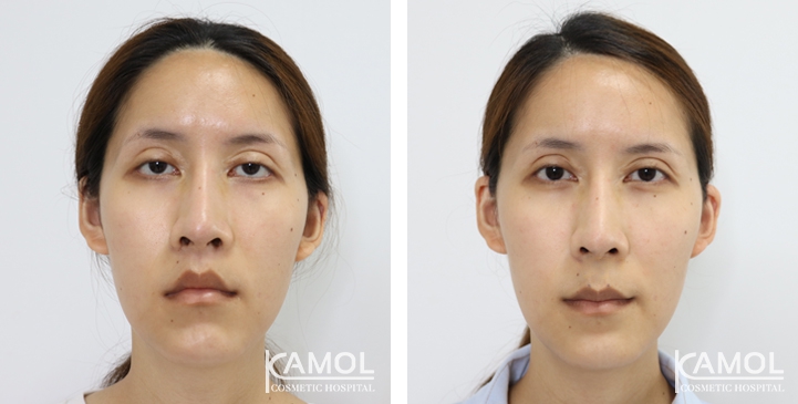 Blepharoplasty / Eyelid Surgery 46 lg 6494958eb8cec image