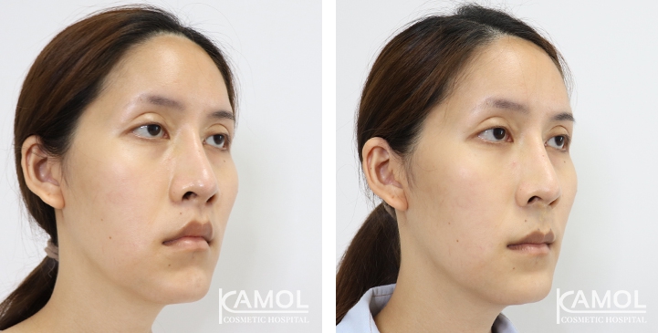 Blepharoplasty / Eyelid Surgery 48 lg 6494958ebad76 image