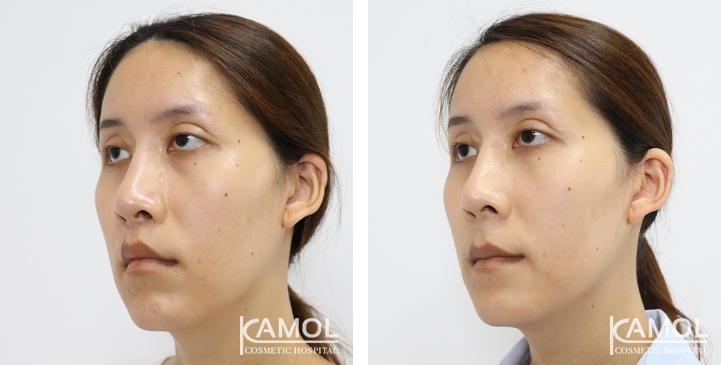 Blepharoplasty / Eyelid Surgery 47 lg 6494958ebcb0d image