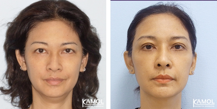 Blepharoplasty / Eyelid Surgery 50 lg 6494958eca80a image
