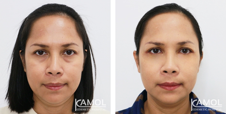 Blepharoplasty / Eyelid Surgery 52 lg 6494958ecd467 image