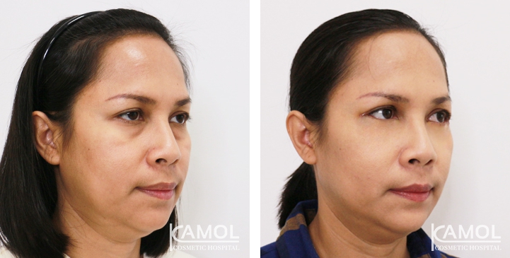 Blepharoplasty / Eyelid Surgery 53 lg 6494958ecf3e3 image