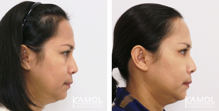 Blepharoplasty / Eyelid Surgery 55 lg 6494958ed1434 image