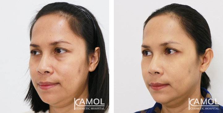 Blepharoplasty / Eyelid Surgery 54 lg 6494958ed32b8 image