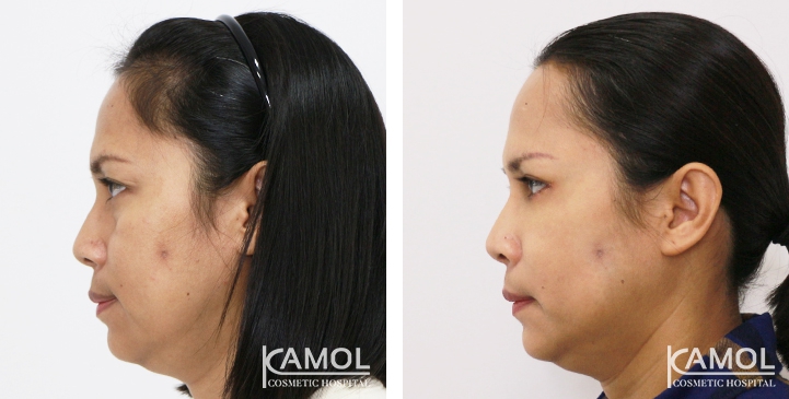 Blepharoplasty / Eyelid Surgery 56 lg 6494958ed5106 image