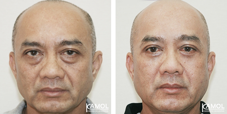 Blepharoplasty / Eyelid Surgery 58 lg 6494958ed7c8c image