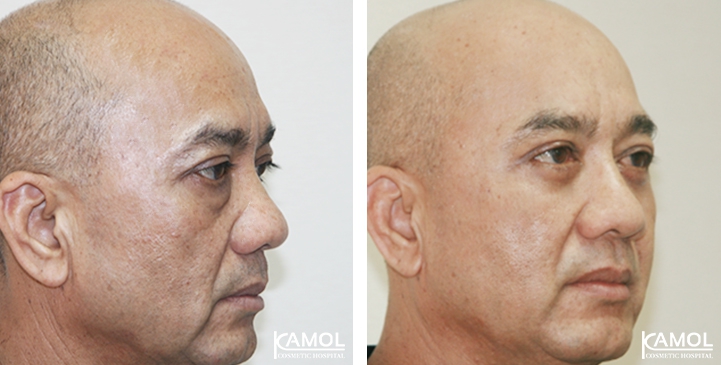 Blepharoplasty / Eyelid Surgery 60 lg 6494958ed9c7c image