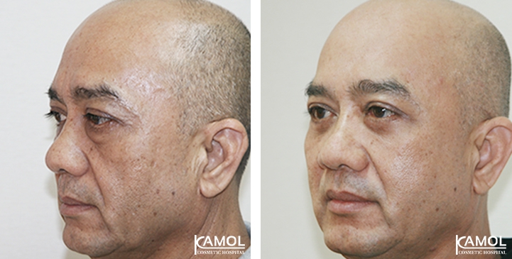 Blepharoplasty / Eyelid Surgery 59 lg 6494958edbc5e image