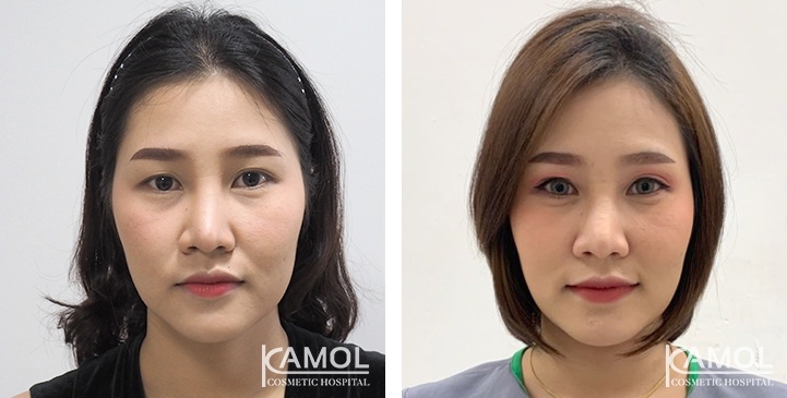 Blepharoplasty / Eyelid Surgery 62 lg 6494958ede53a image