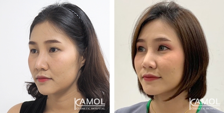 Blepharoplasty / Eyelid Surgery 64 lg 6494958ee0583 image