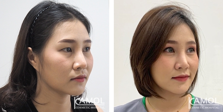 Blepharoplasty / Eyelid Surgery 63 lg 6494958ee2361 image